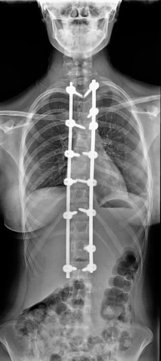 X-ray showing scoliosis correction