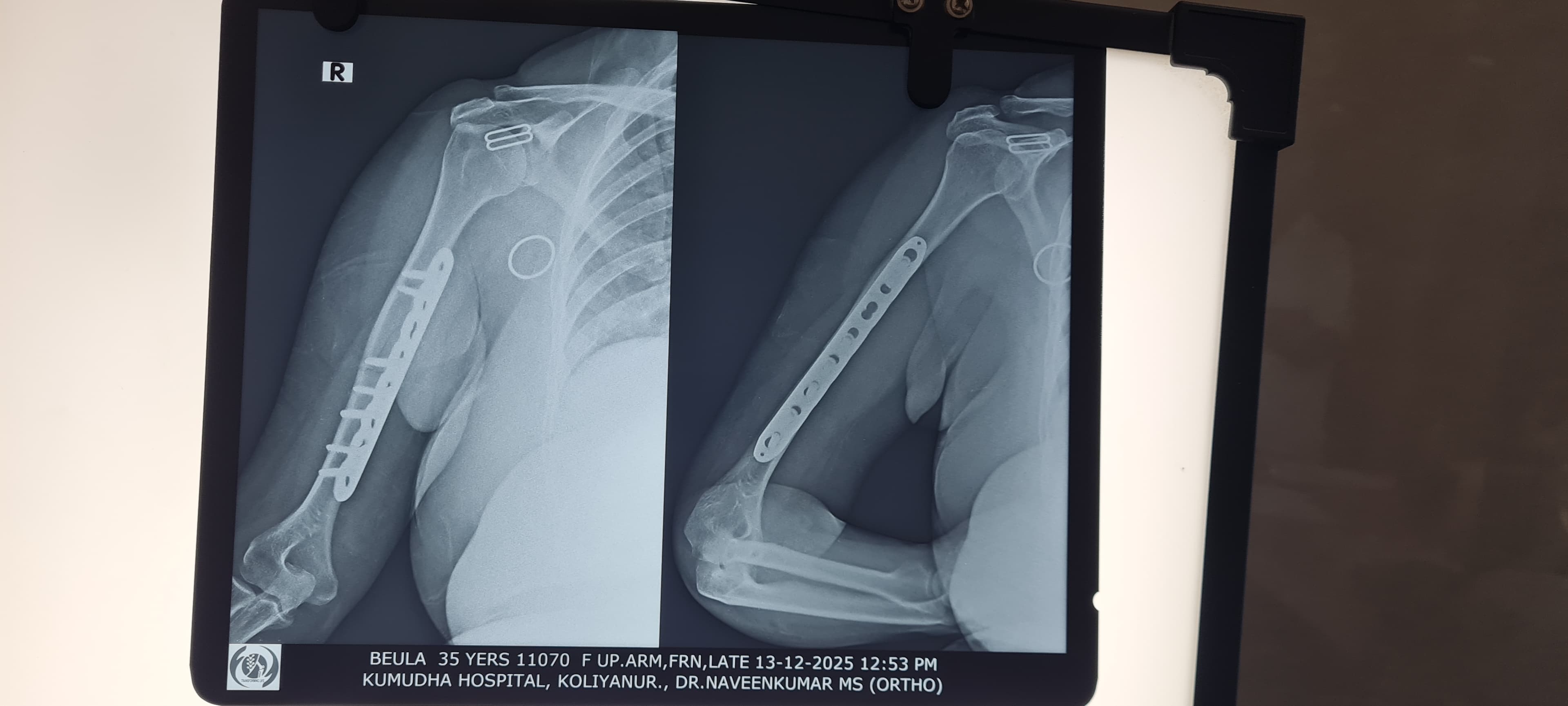 Post-operative X-ray of a fixed upper-arm fracture