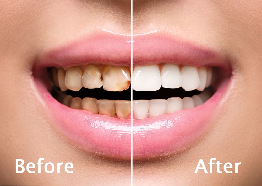 Dental smile makeover — before and after teeth whitening