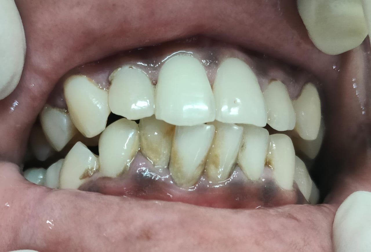 Orthodontic options — lingual, metal, ceramic braces and clear aligners