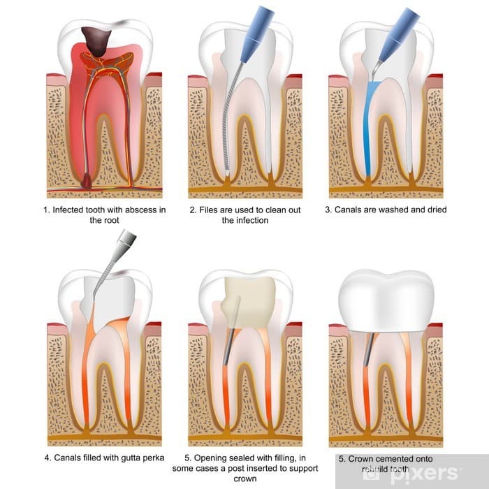 Root canal treatment — step by step