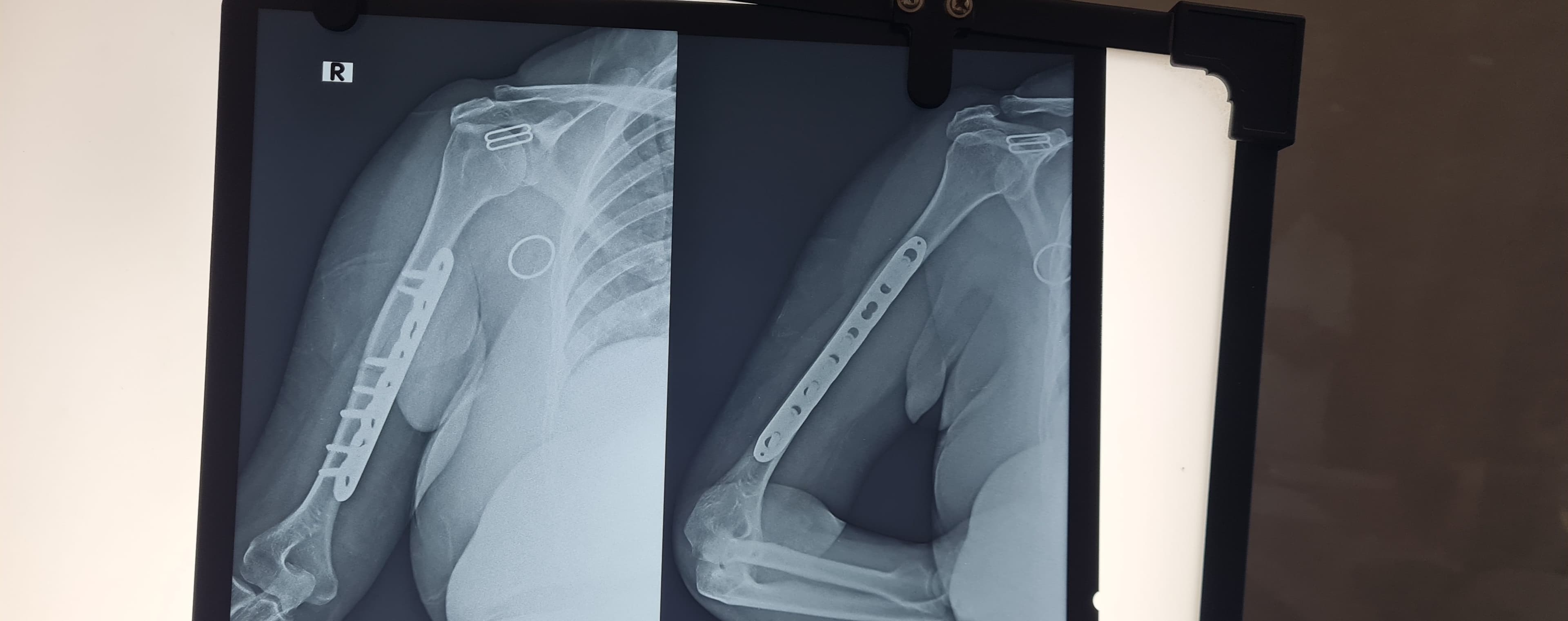 Post-operative X-ray of upper-arm fracture fixation with plate and screws