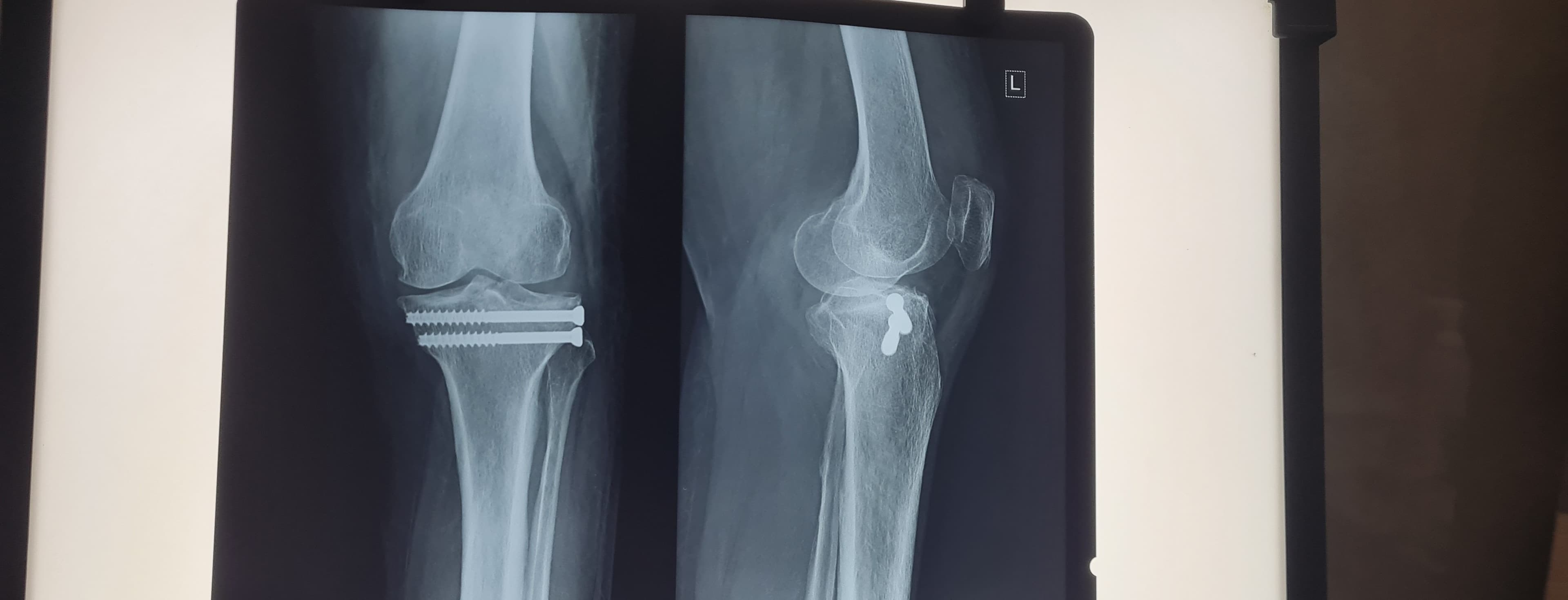 Post-operative X-ray of knee fracture fixation with screws