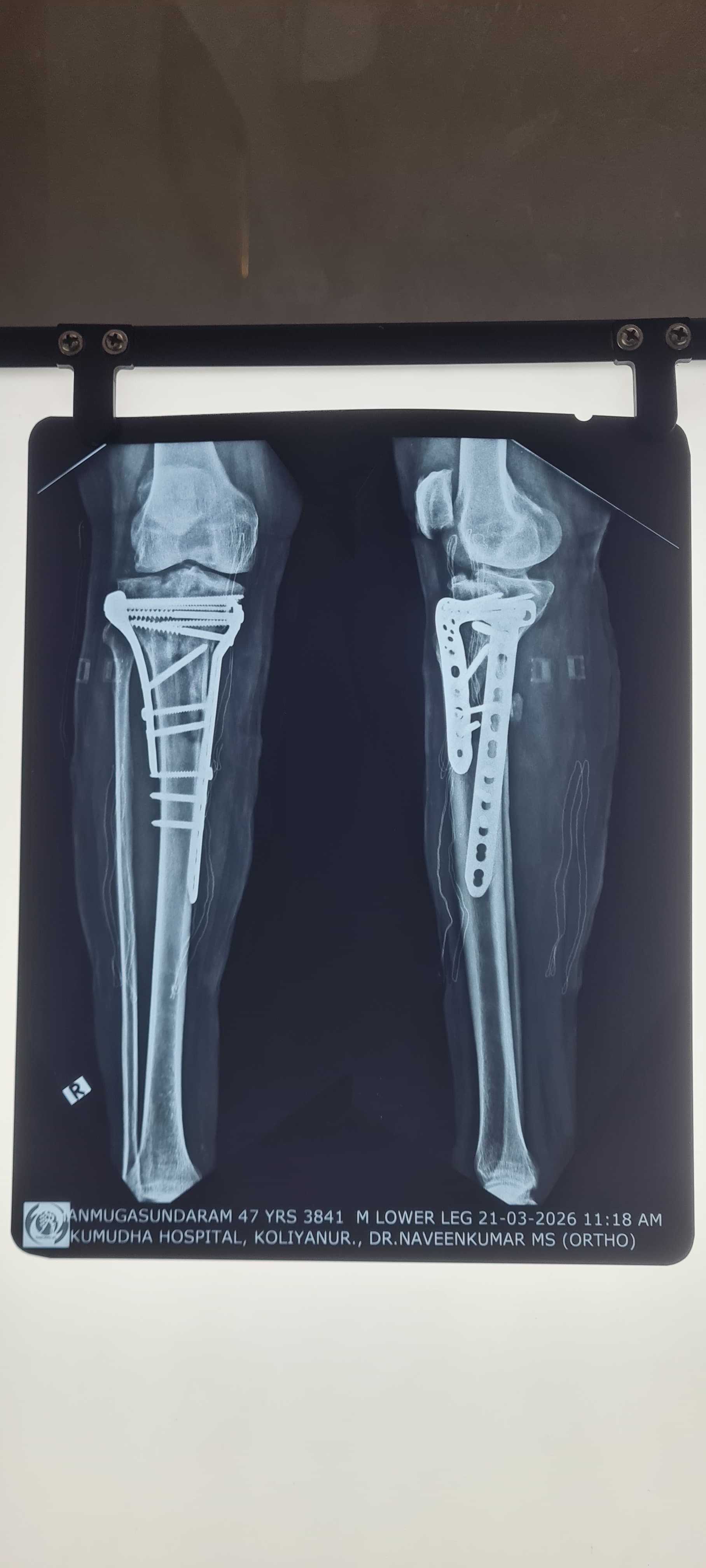 Post-operative X-ray of a fixed lower-leg fracture