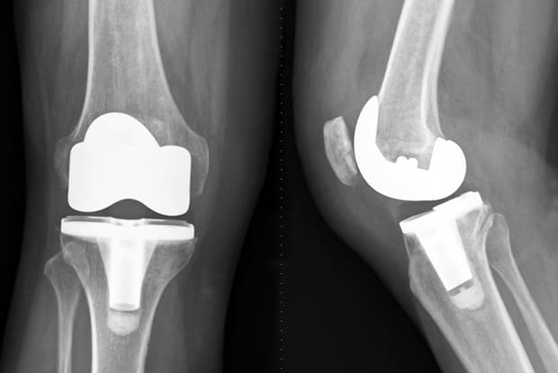 Post-operative X-ray of a total knee replacement